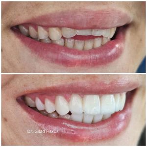 open bite מנשך פתוח - ד"ר גלעד פיסקוס