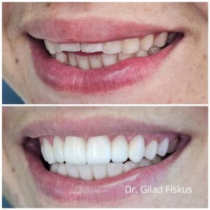 מנשך פתוח אופן בייט עקב מציצת אצבע - ד" גלעד פיסקוס