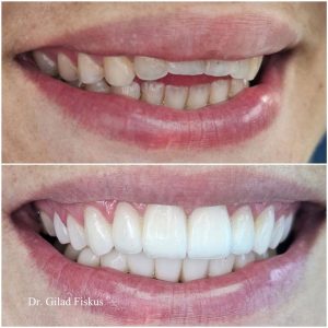 open bite מנשך פתוח - ד"ר גלעד פיסקוס