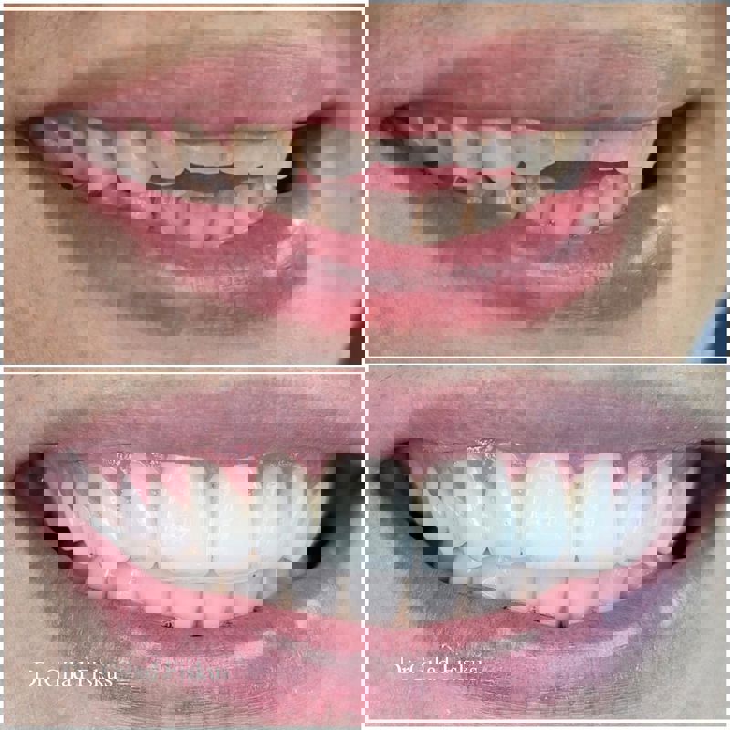 open bite מנשך פתוח - ד"ר גלעד פיסקוס