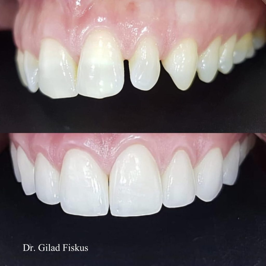 סגירת רווחים בשיניים